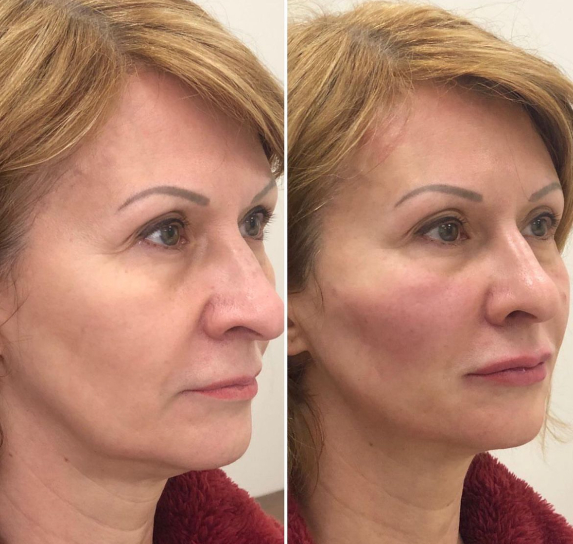 stylage-filler-treatment-face-sculpting
