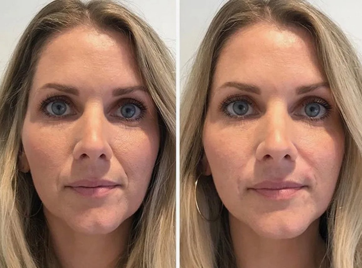 Stylage Filler Treatment before and after, improving skin smoothness and facial appearance.
