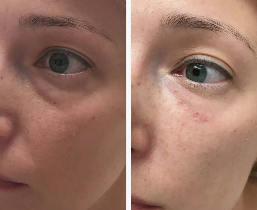 Stylage Filler Treatment before and after results, reducing under-eye bags and smoothing skin texture.