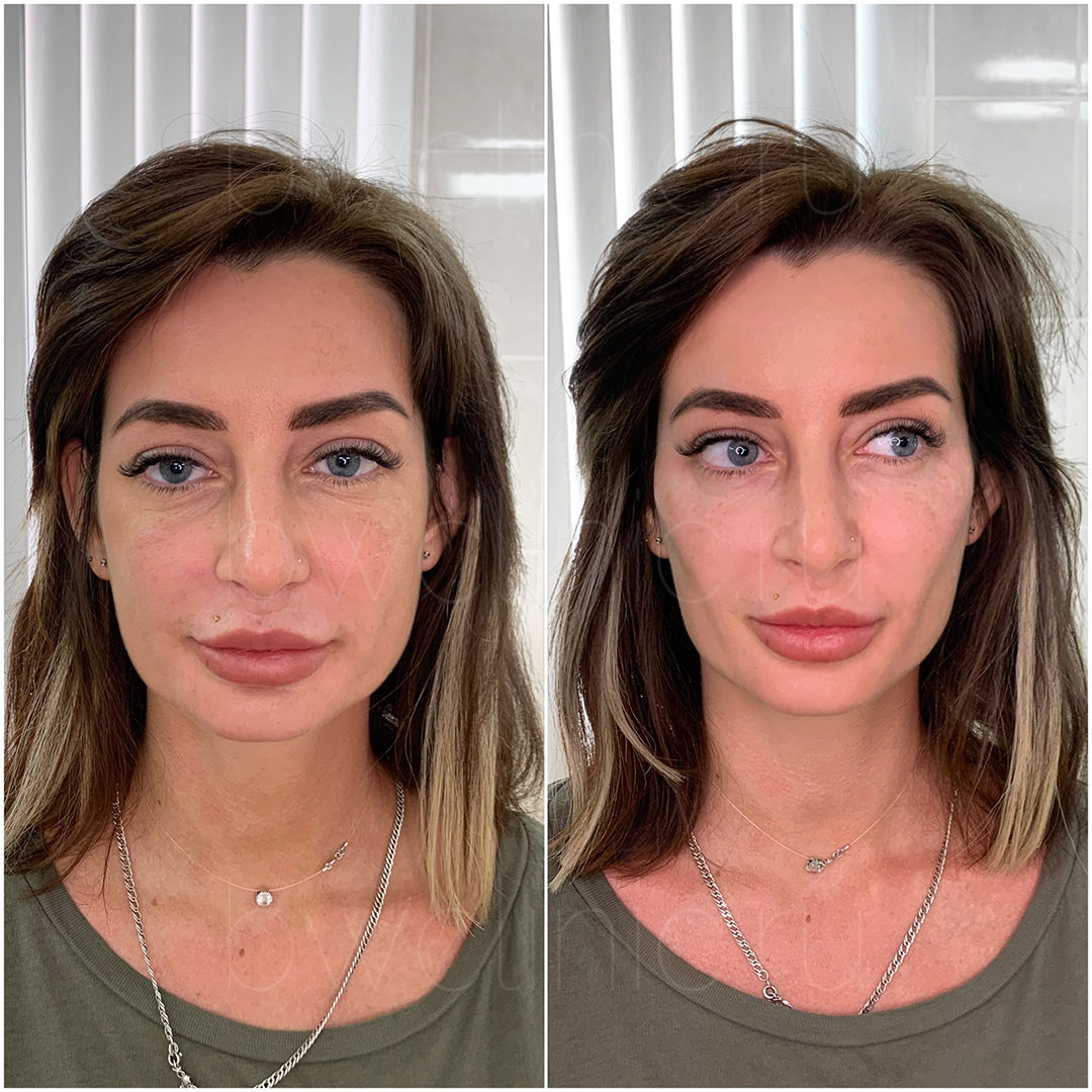 Before and after Temple Filler Treatment showcasing enhanced facial volume and smoothness.