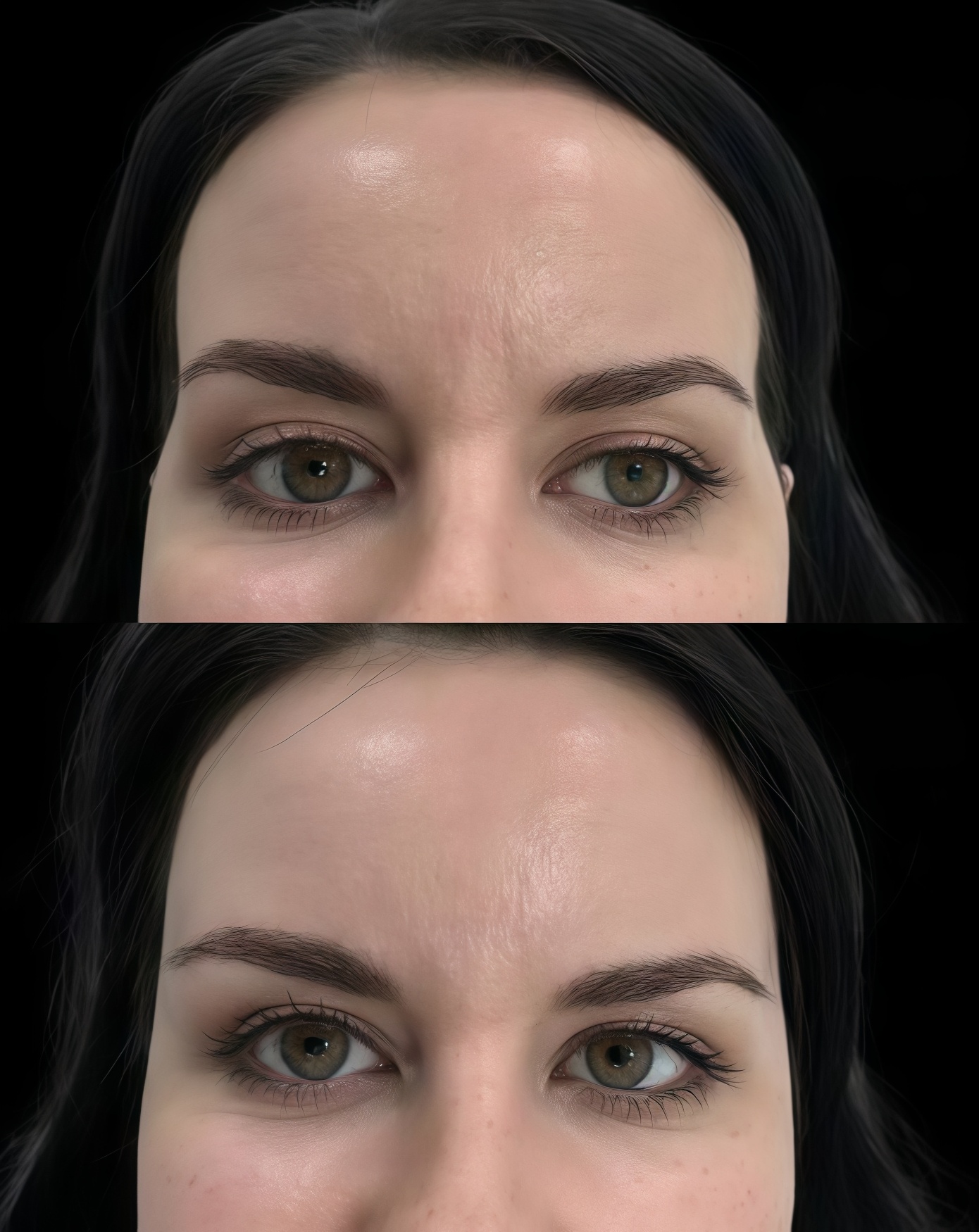 temple-filler-treatment-forehead-before-after.jpg