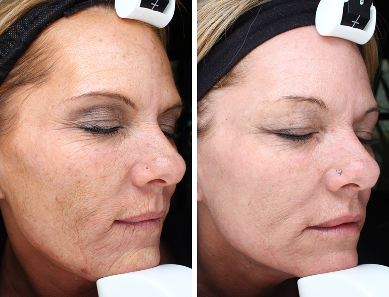 teosyal-filler-facial-rejuvenation-before-after