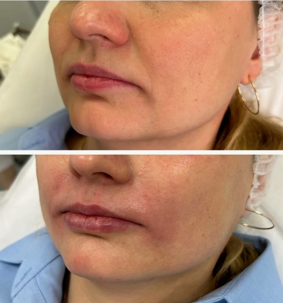 Before and after Teosyal Filler Treatment improving lip volume and contour for a fuller, natural look.