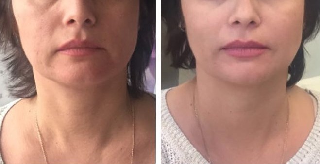 Before and after Teosyal Filler Treatment rejuvenating the neck area by reducing sagging and smoothening skin.