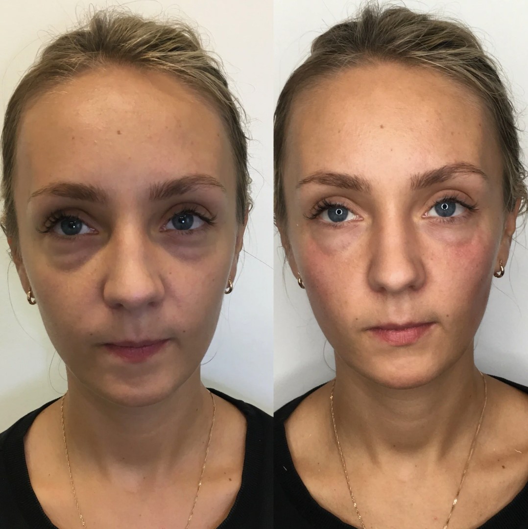 Before and after Teosyal Filler Treatment enhancing facial contours and reducing under-eye hollows.