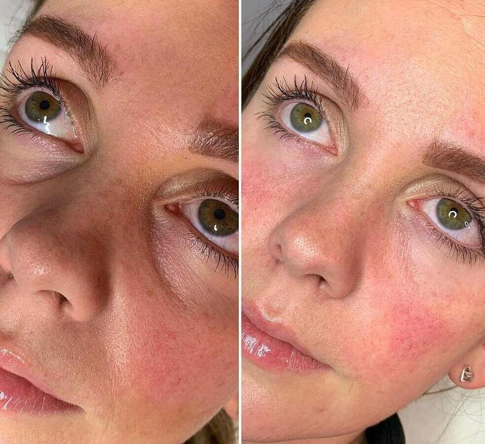 teosyal-filler-under-eye-treatment-before-after