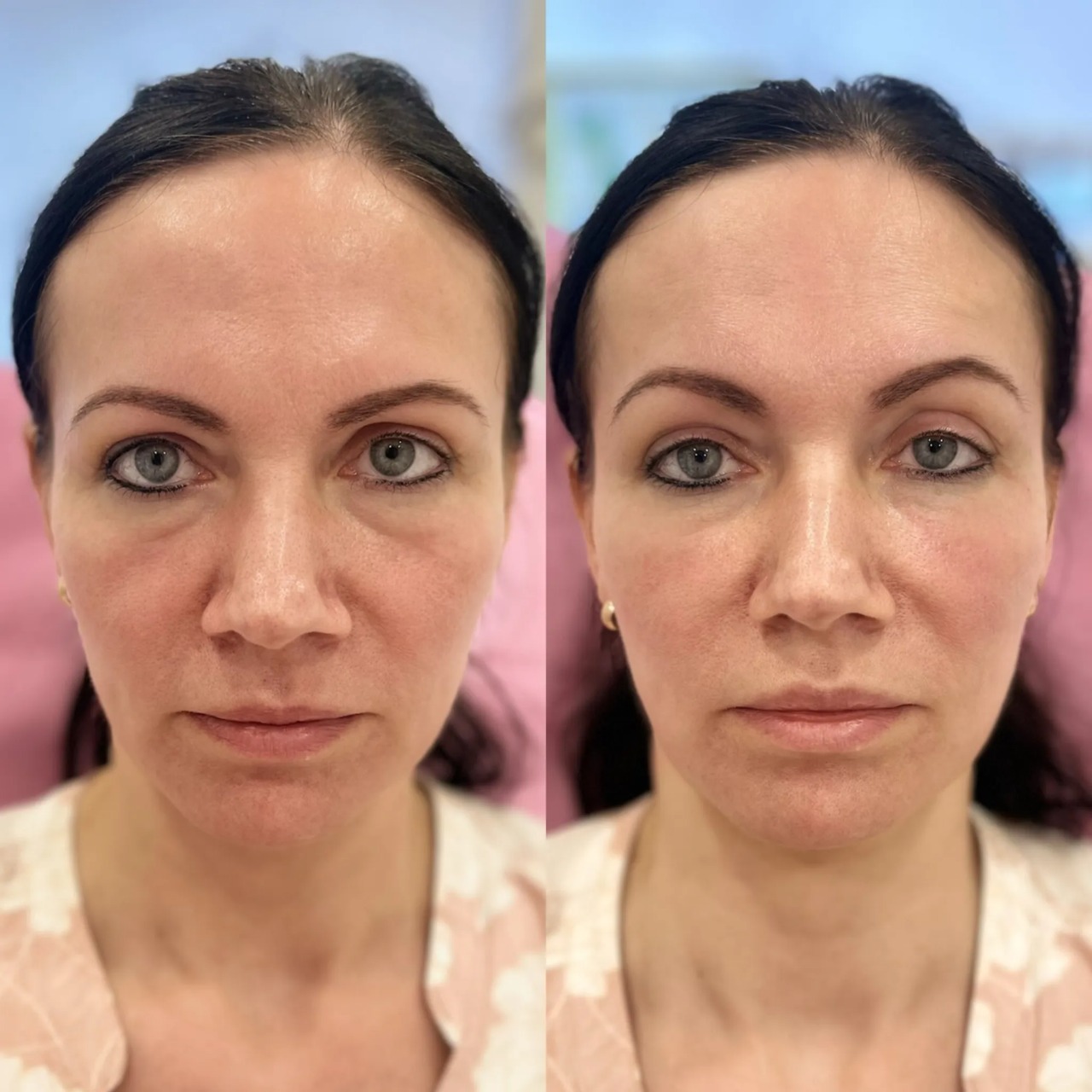 Before and after Under Eye Filler Treatment rejuvenating the under-eye area for a fresher look.