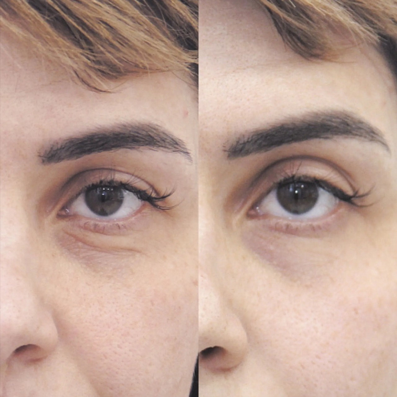 under-eye-filler-treatment-before-after.jpg