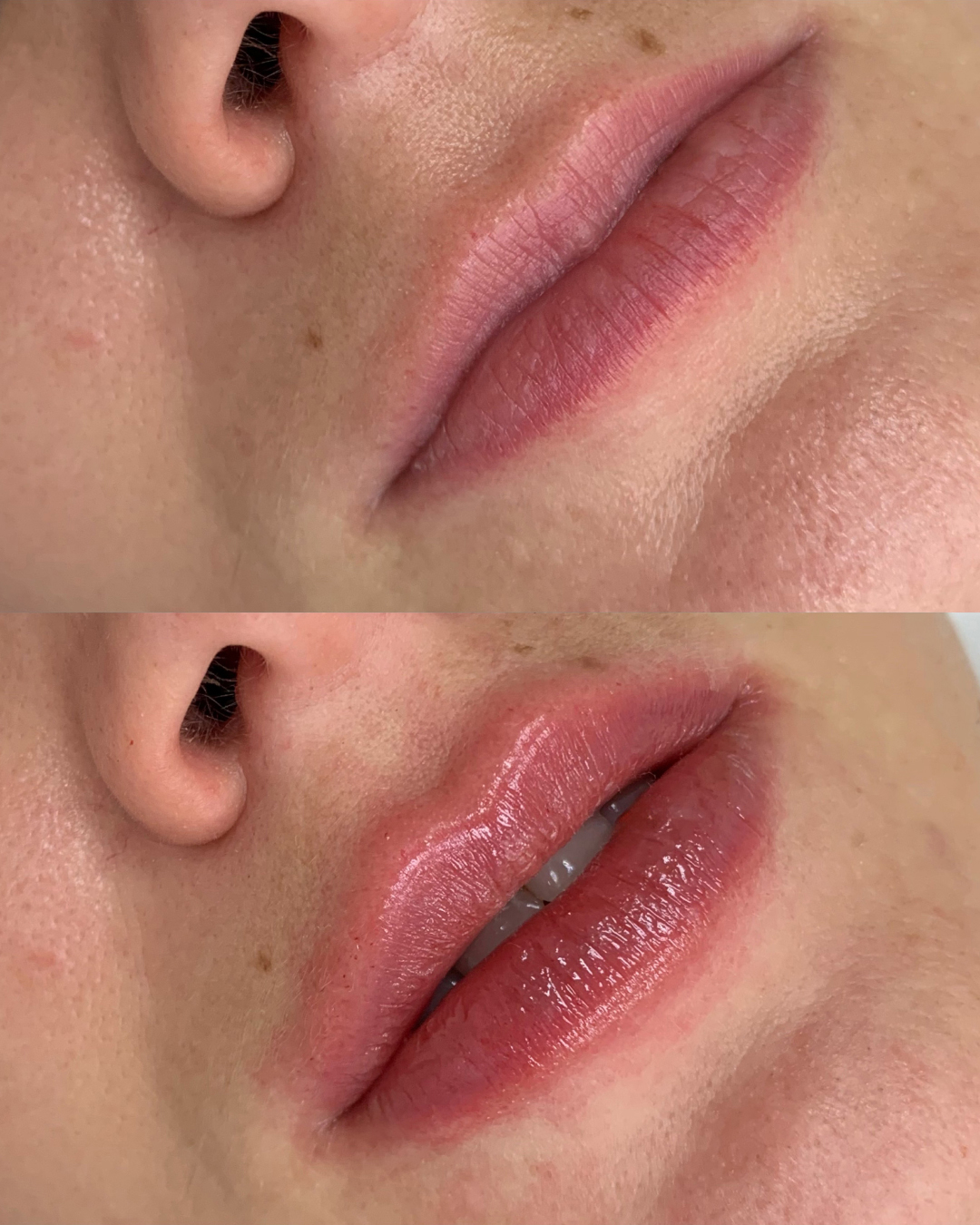0.5ml Lip Filler