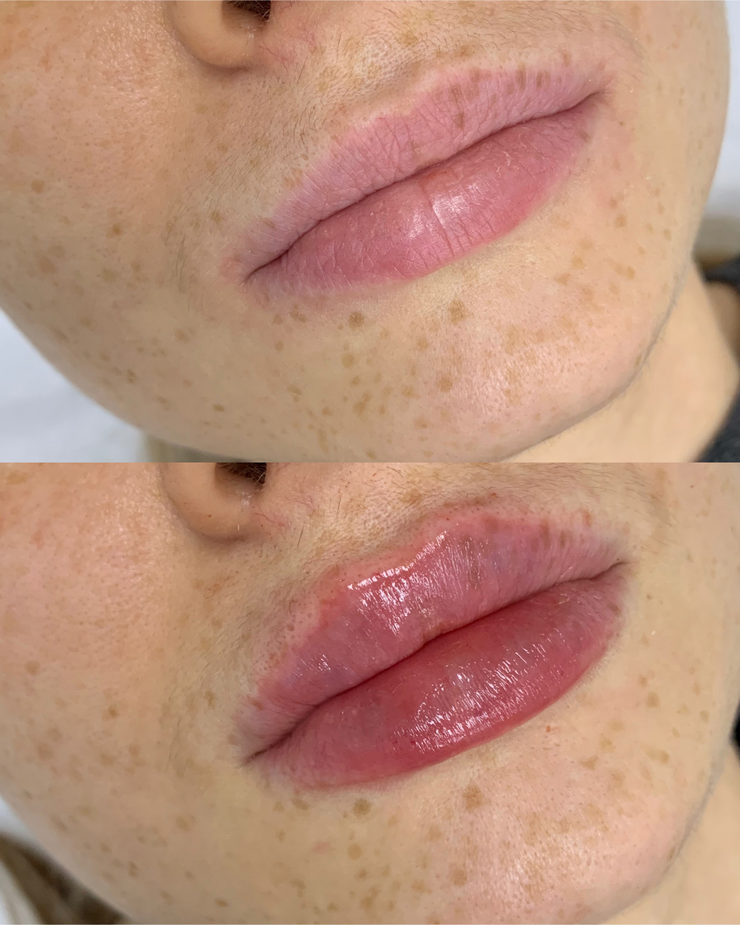 1ml Lip Filler