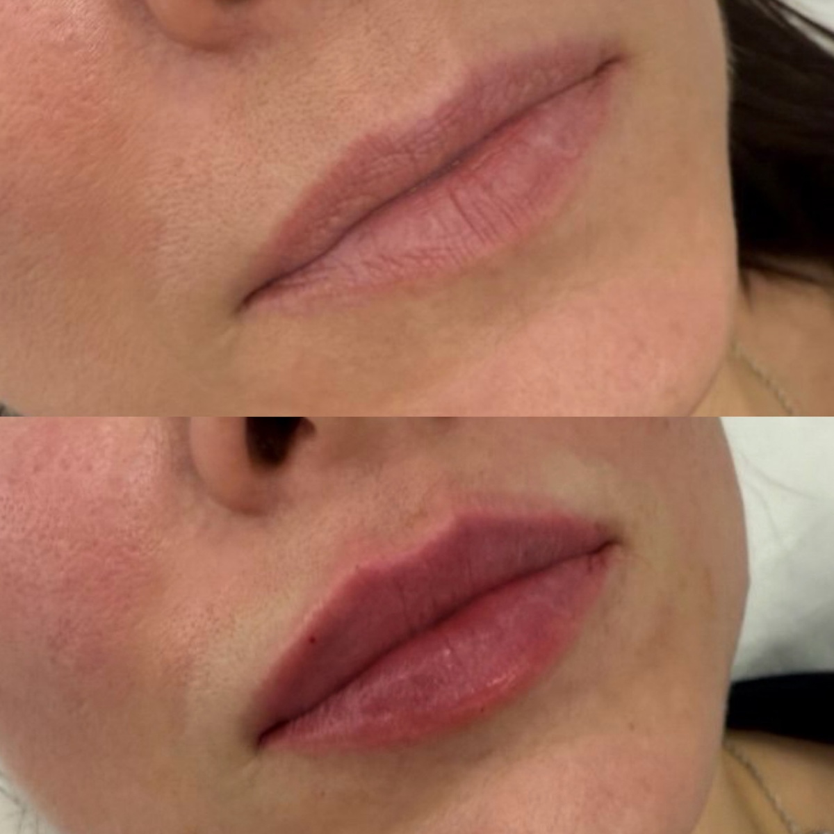 1ml Lip Filler or lips
