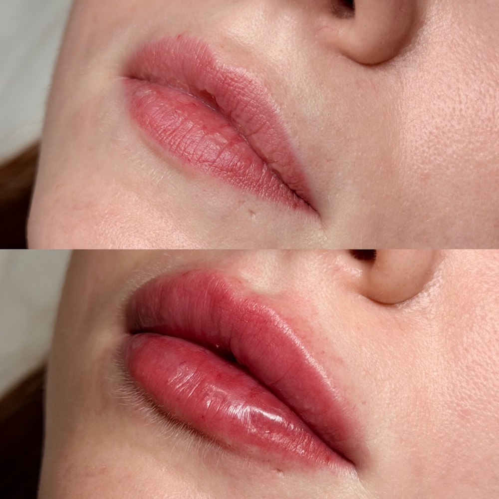 1ml Lip Filler or lips(1)