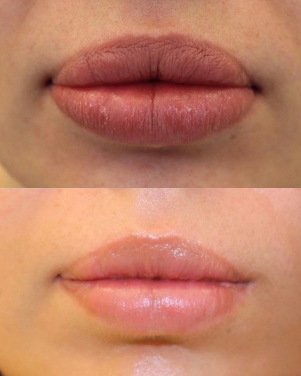 Filler Dissolving(1)