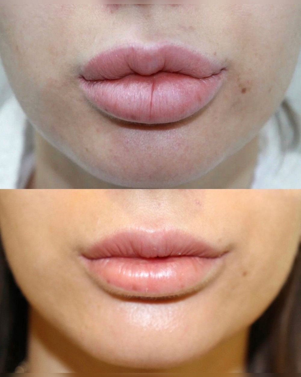 Filler Dissolving(2)