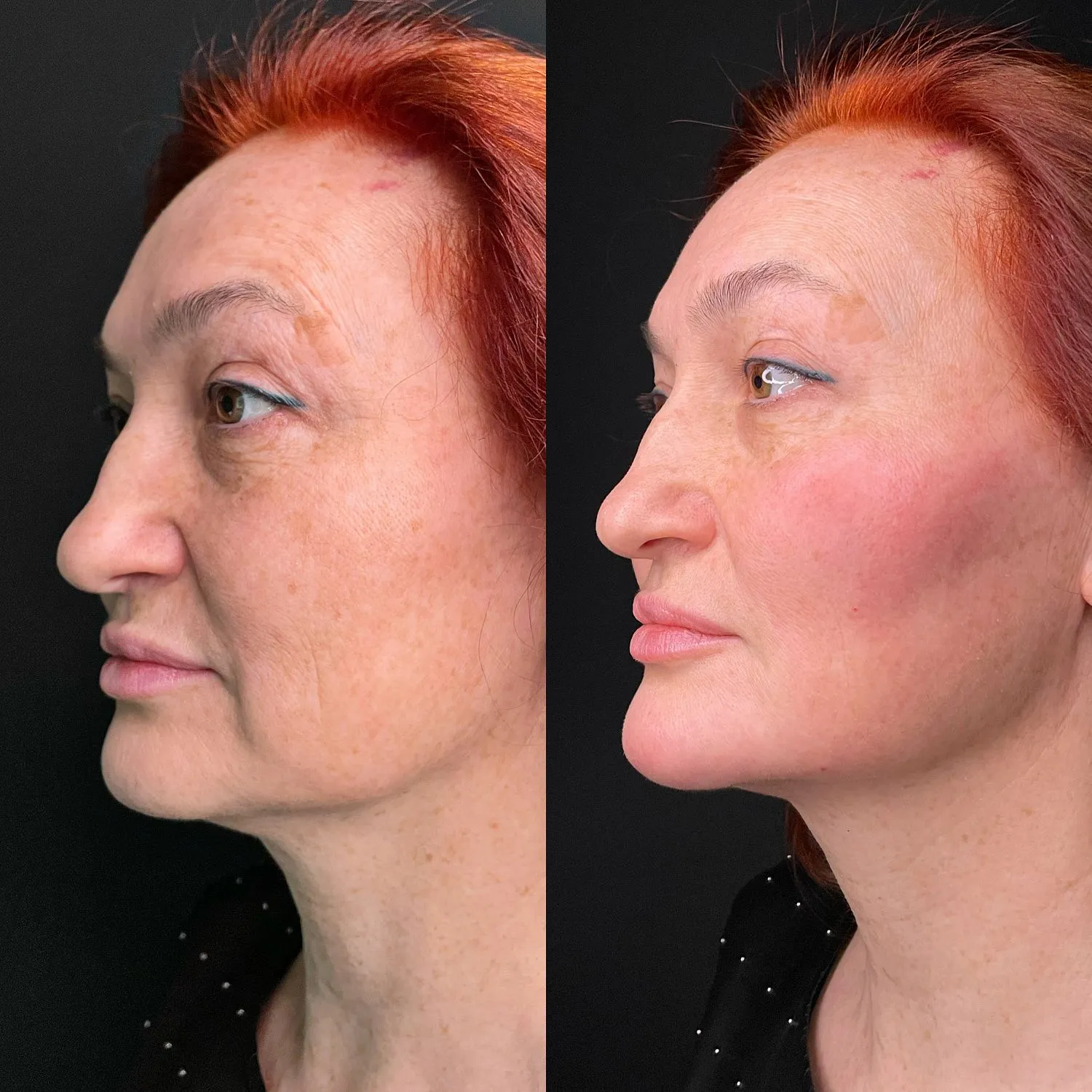 Full Face Filler(1)