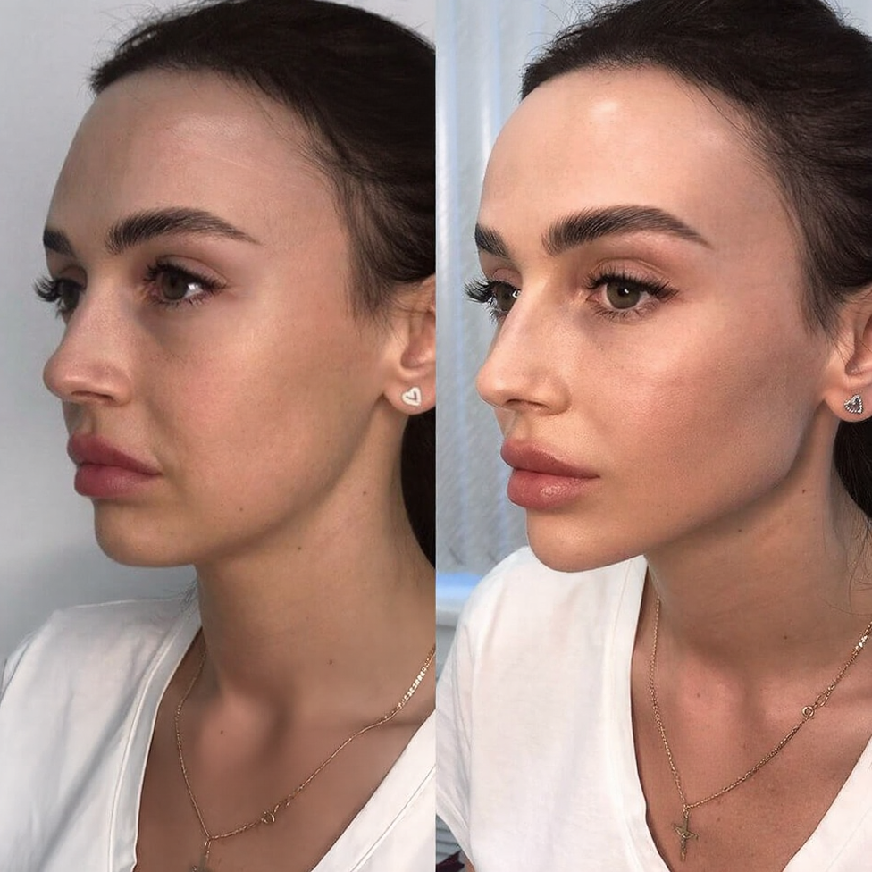 Full Face Filler(2)