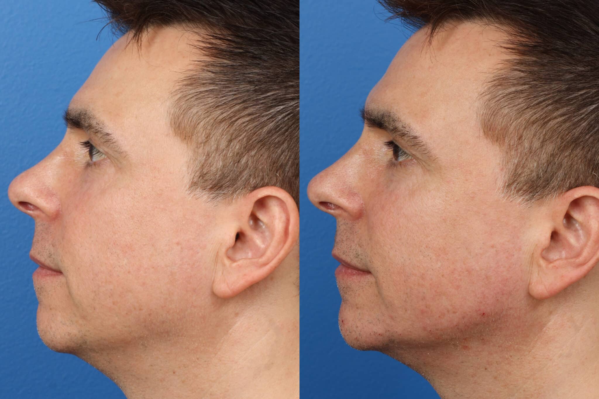 Before and after of male jaw contouring in new york