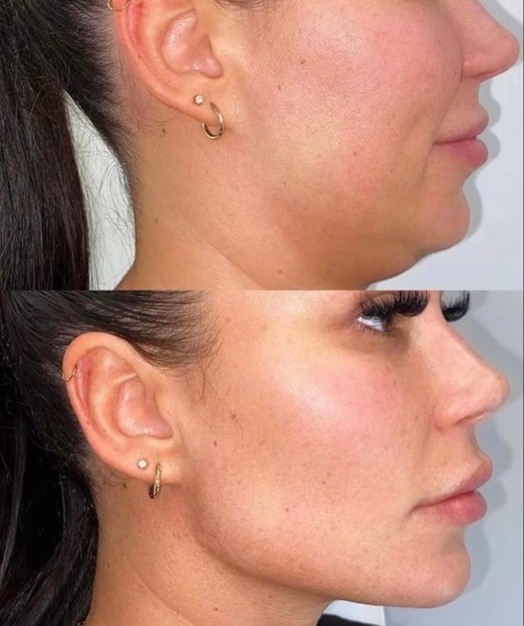 Jawline Filler(2)