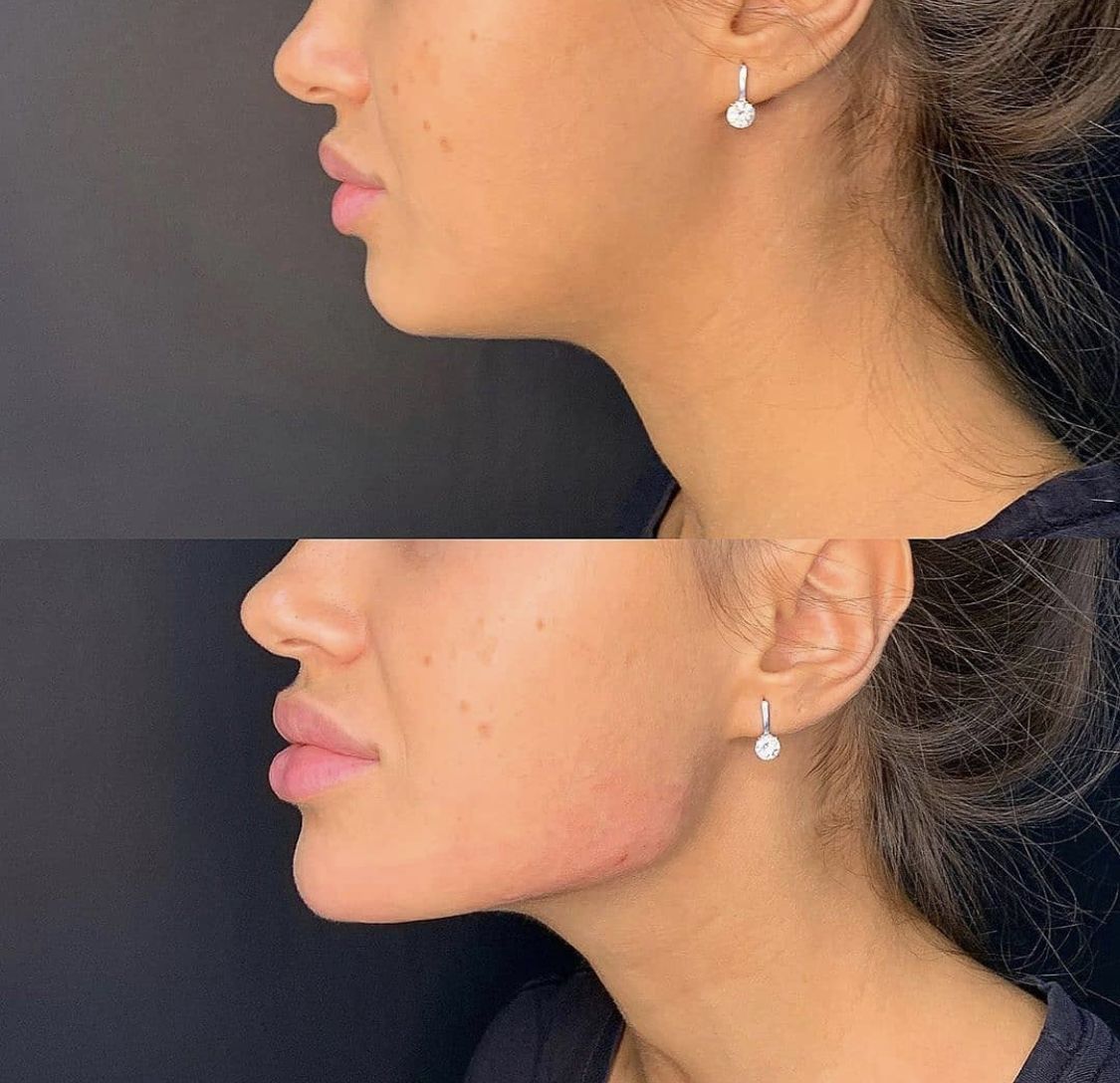 Jawline Filler(3)