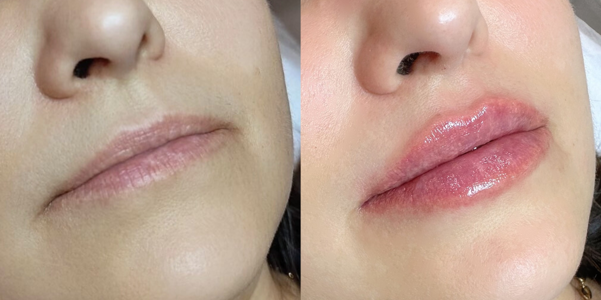 Juvederm Lip Filler