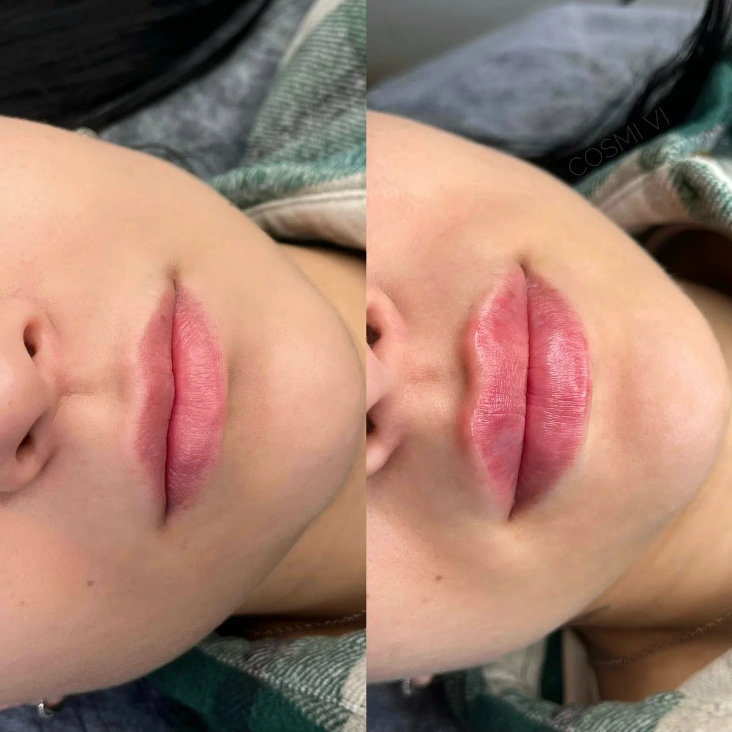 Lip Enhancement(1)