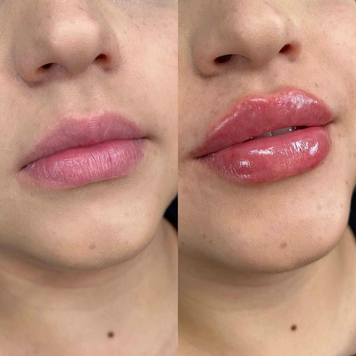 Lip Filler