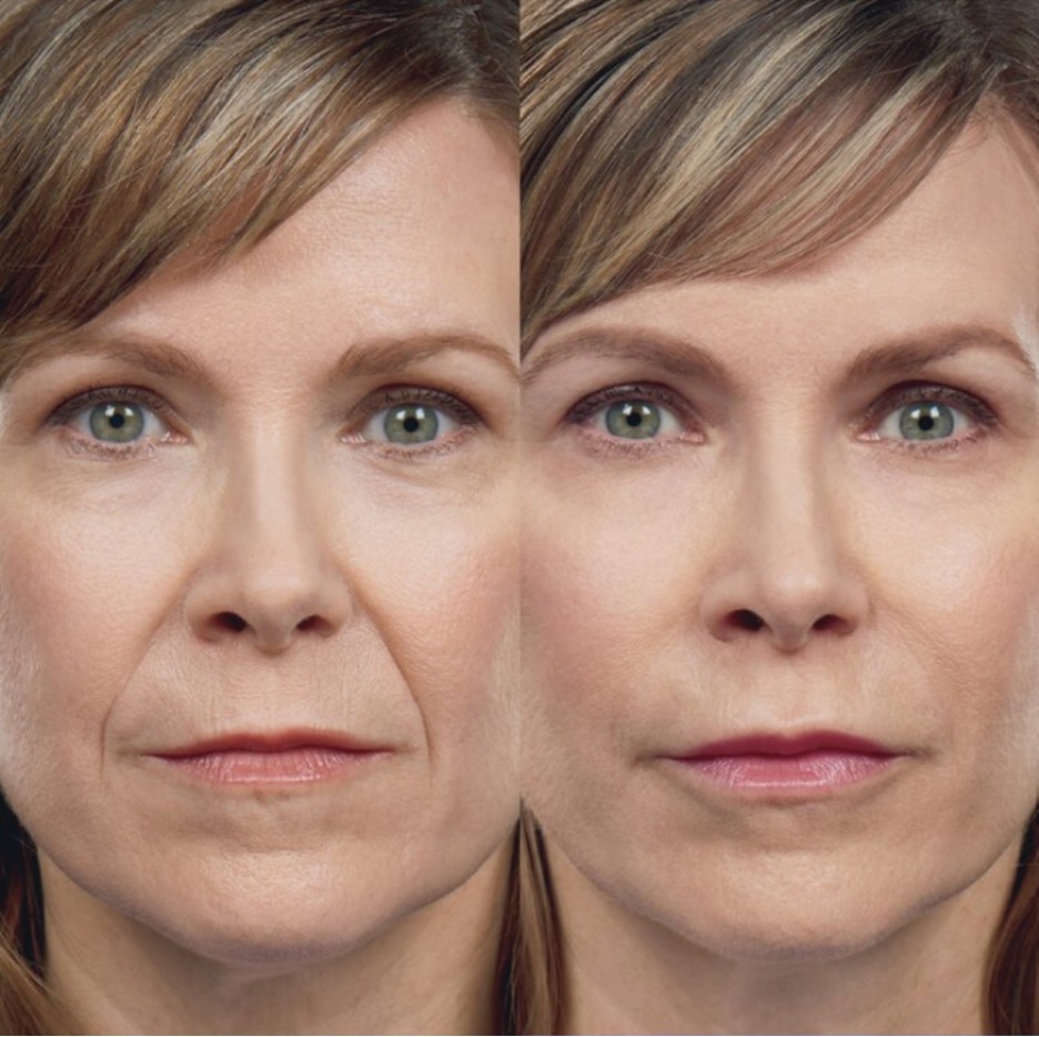 Nasolabial Fold Filler