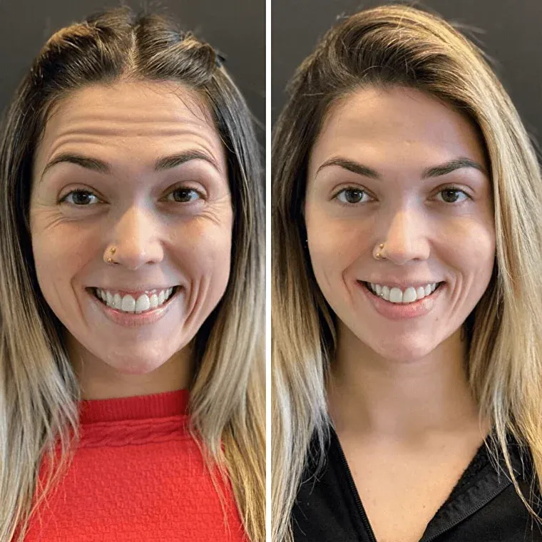 Botox injections targeting forehead lines, frown lines, and crow’s feet for a smoother and more youthful look