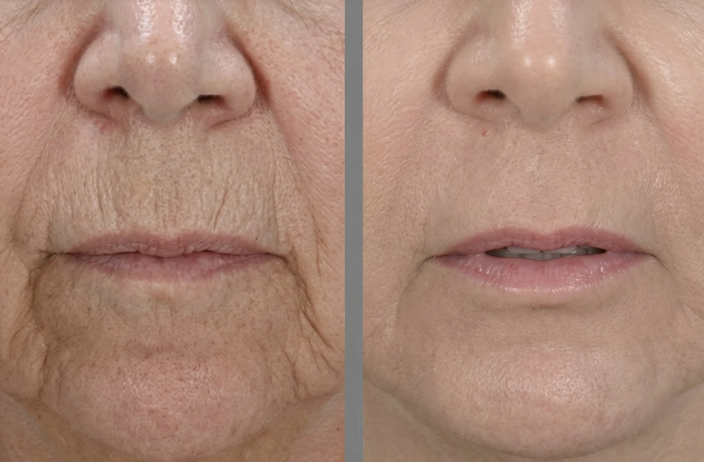 Botox treatment reducing perioral lines and wrinkles around the lips for a smoother appearance