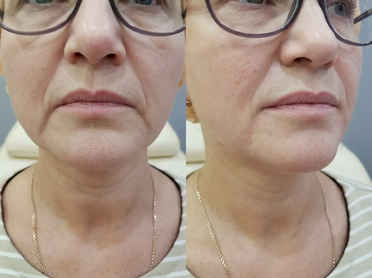 Dermal filler treatment reducing marionette lines and smoothing folds between the mouth and chin