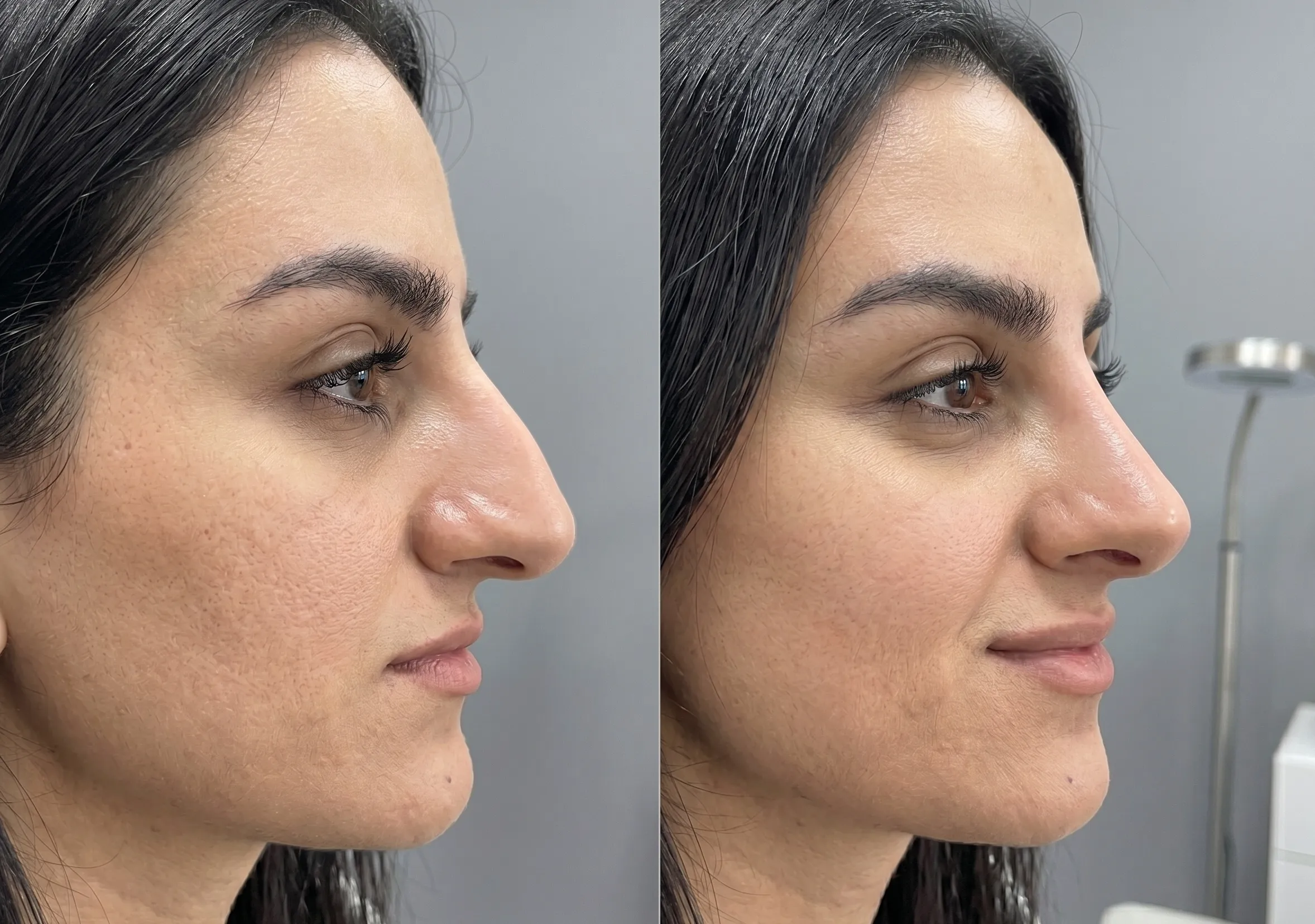 Non-surgical rhinoplasty treatment in a London clinic using dermal fillers to reshape and refine the nose