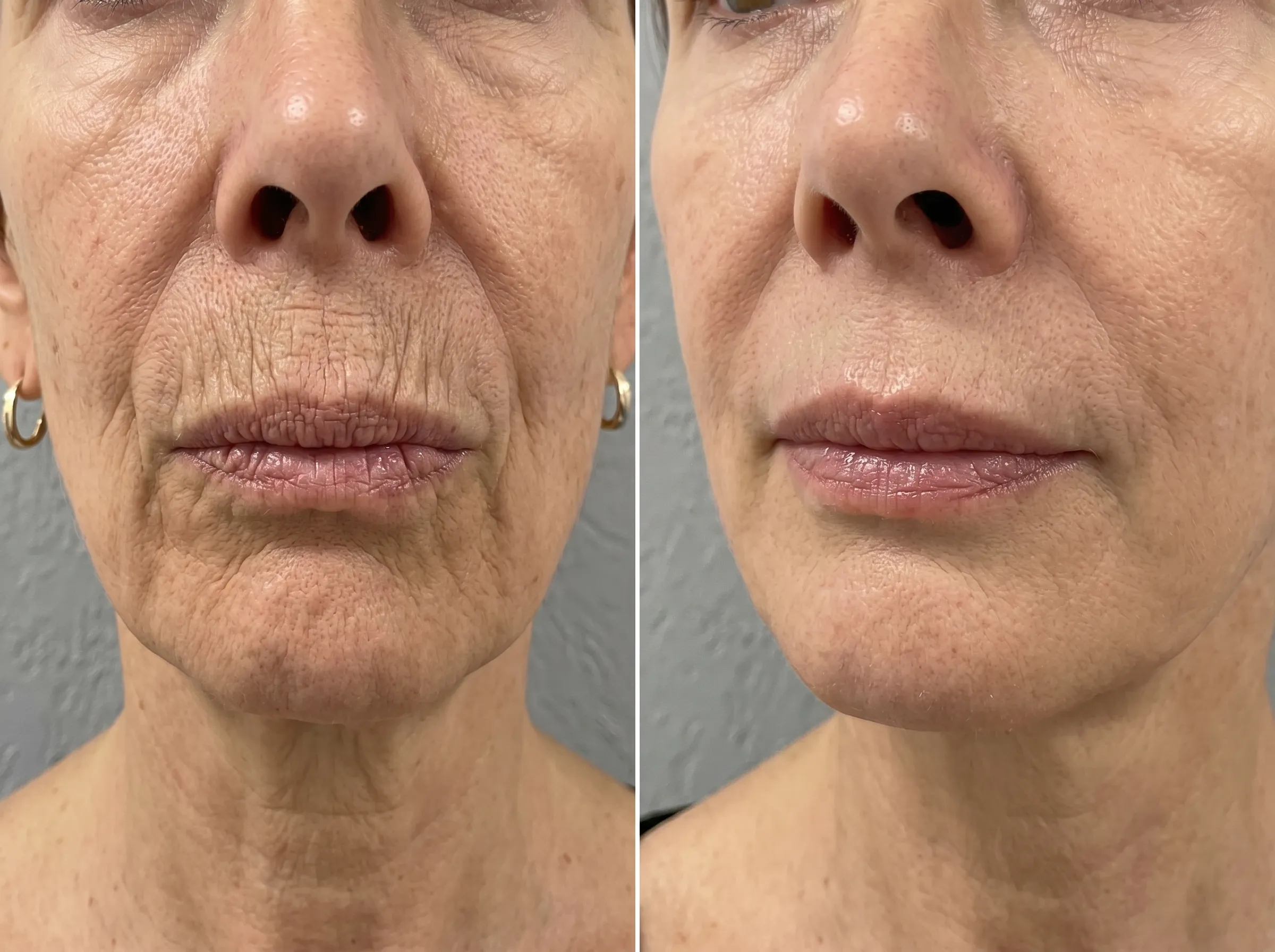 Smoker’s line filler treatment in a London clinic to smooth vertical lip lines and rejuvenate the mouth area