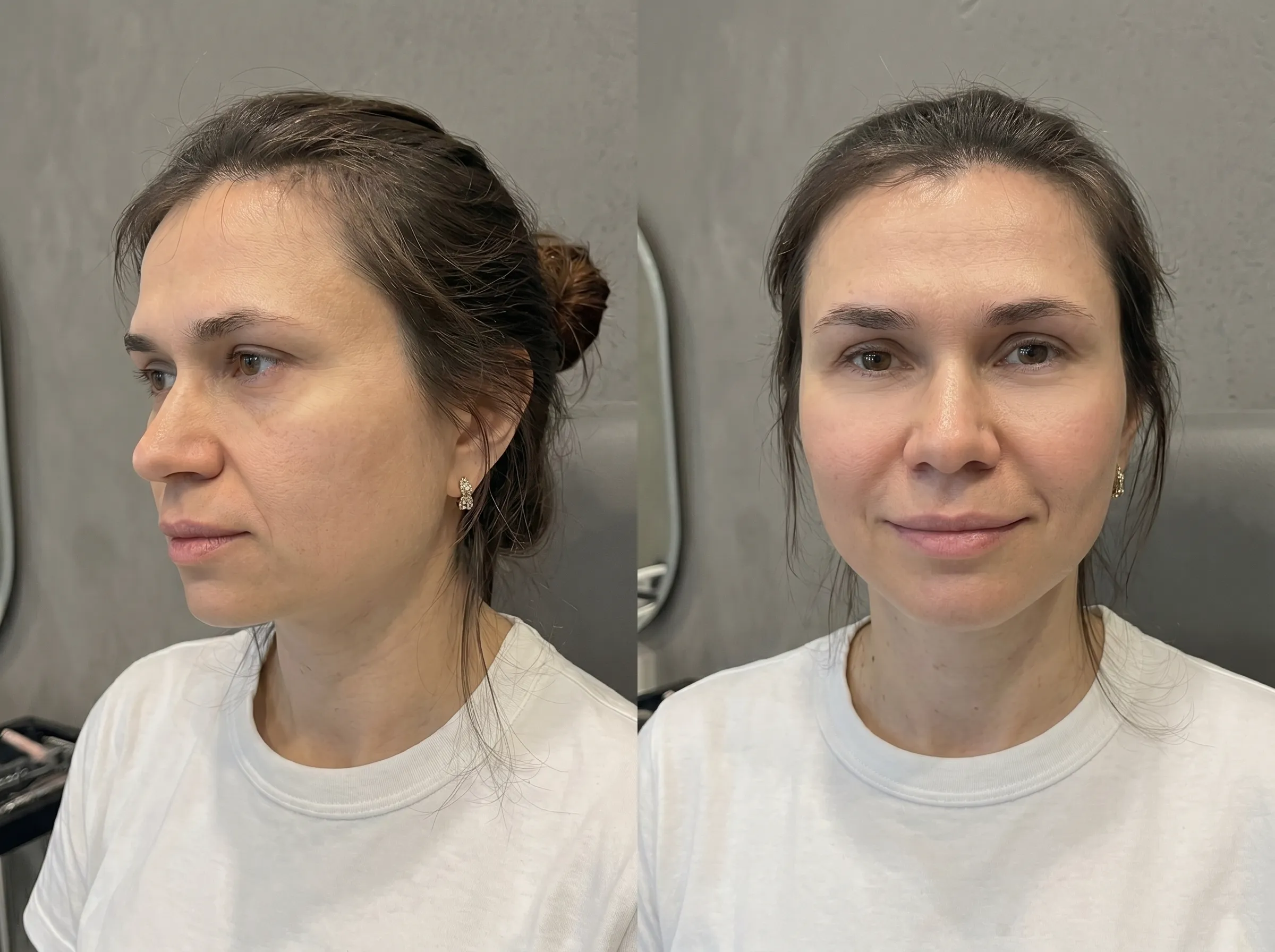 London Aesthetics clinic offering expert liquid facelift treatments with personalised care and natural-looking results