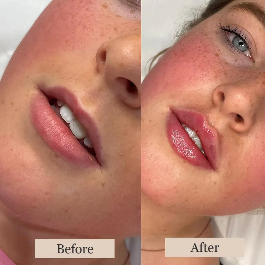 Before and After Thin Lip Filler Treatment