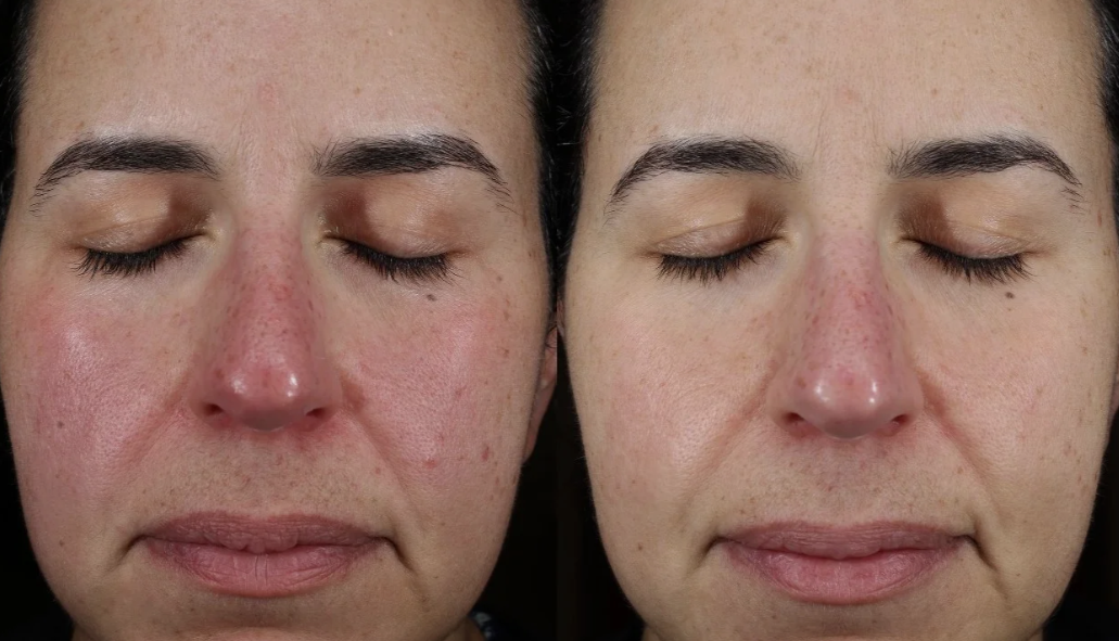 after-exosomes-face-treatment