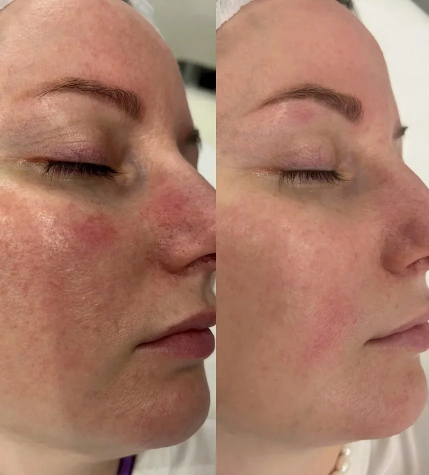 after-exosomes-rosacea-treatment