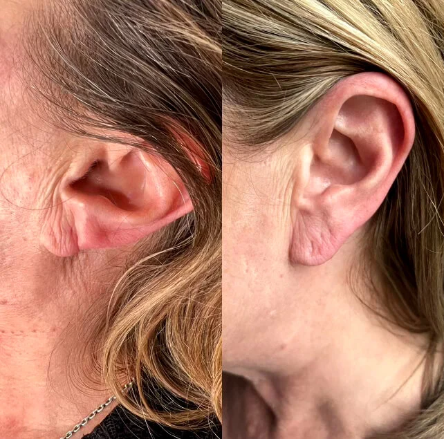 before-and-after-earlobe-filler