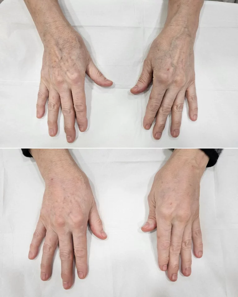 before-and-after-hand-filler-treatment