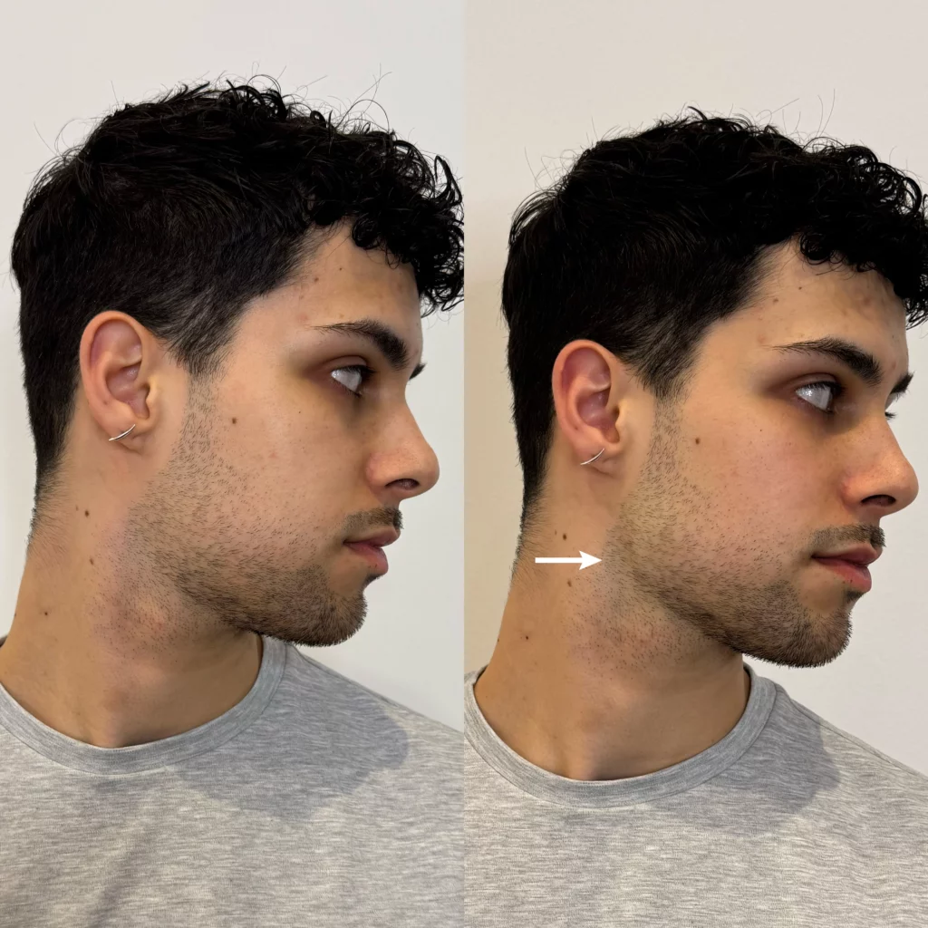 before-and-after-jowl-filler