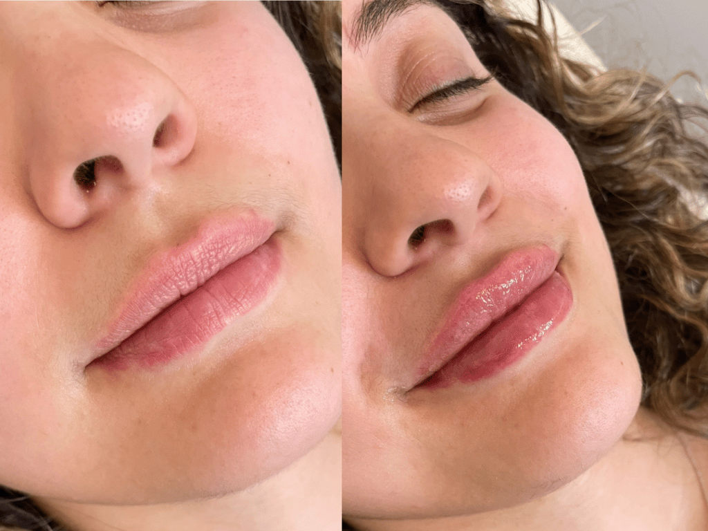 cupids-bow-lip-filler-before-and-after