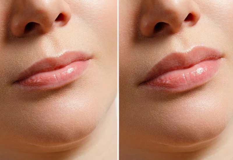 Cupid's Bow Lip Filler in London