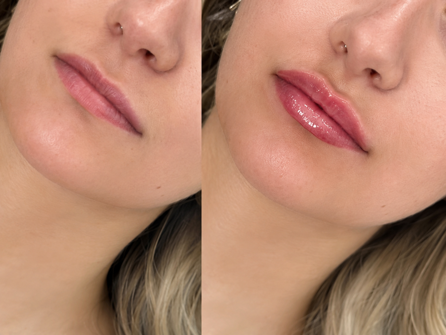cupids-bow-results-longevity-and-recovery