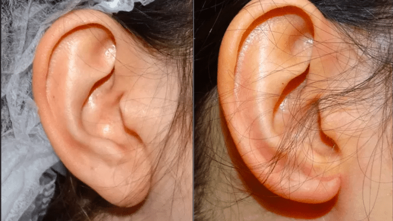 earlobe-rejuvenation-filler-restoring-volume-thin-or-elongated-earlobes