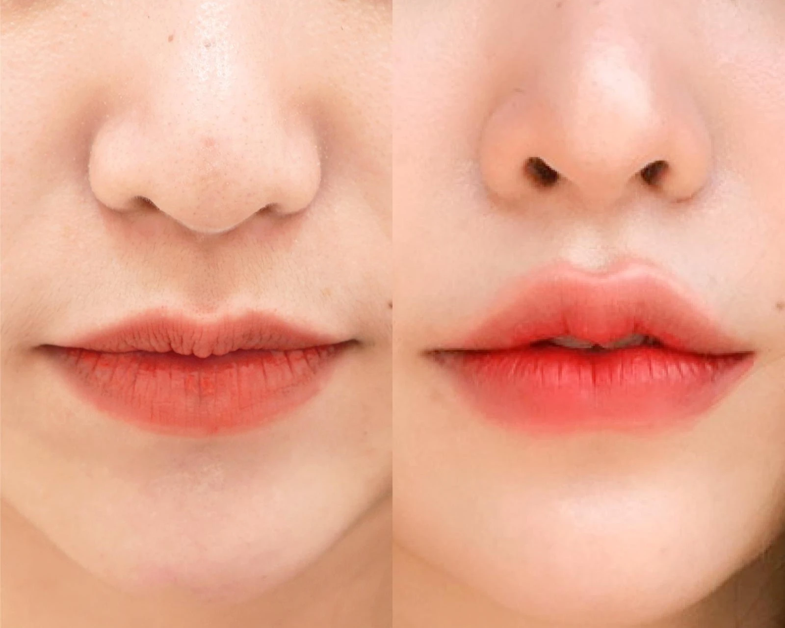 enhancing-lip-shape-definition-and-cupids-bow-contour