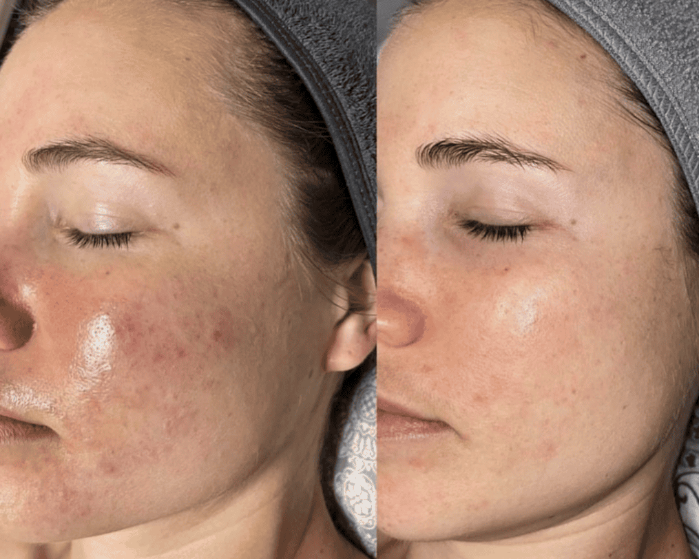 exosomes-face-treatment-results