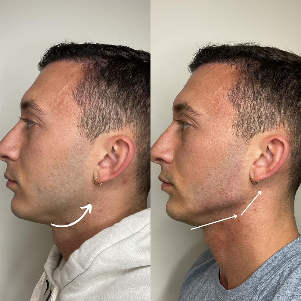 improving-lower-face-definition-and-jaw-contour