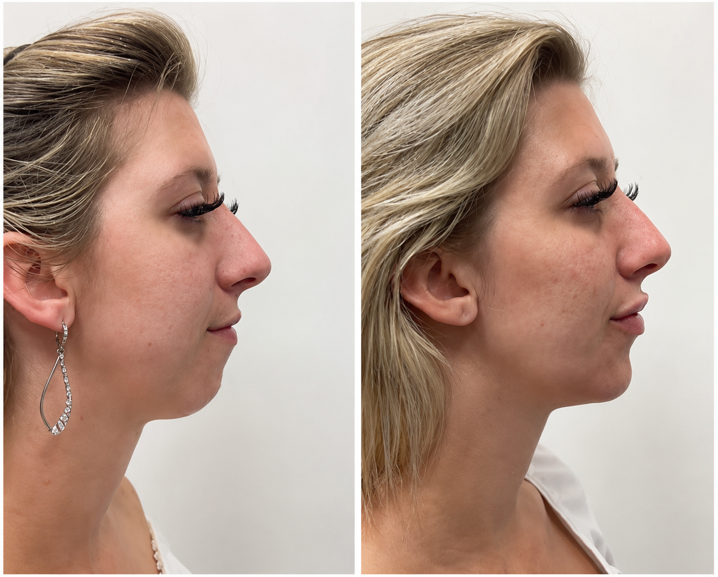jowl-filler-results-longevity-and-recovery