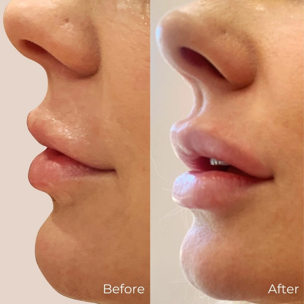 lip-filler-before-after