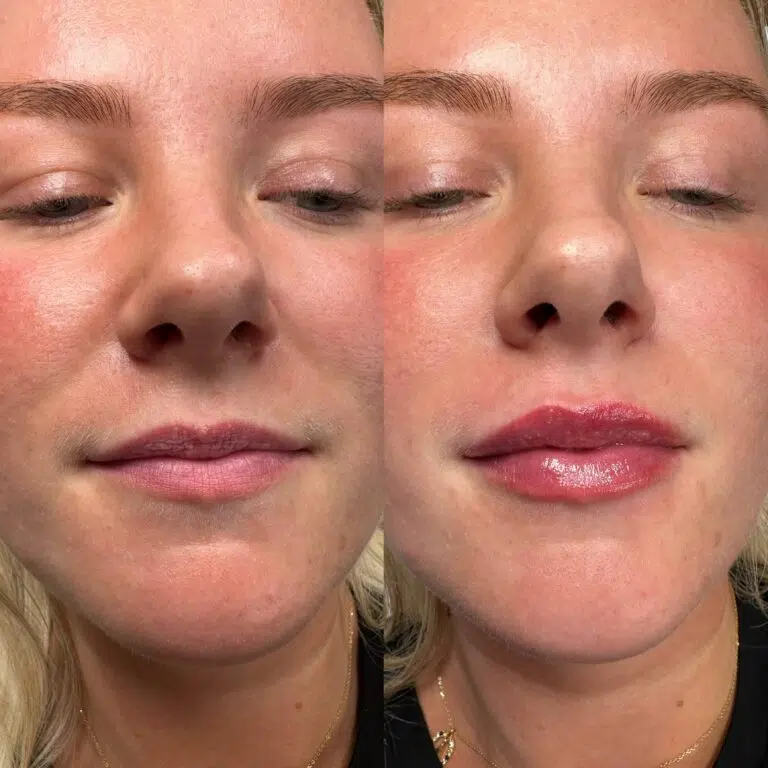 lip-filler-results
