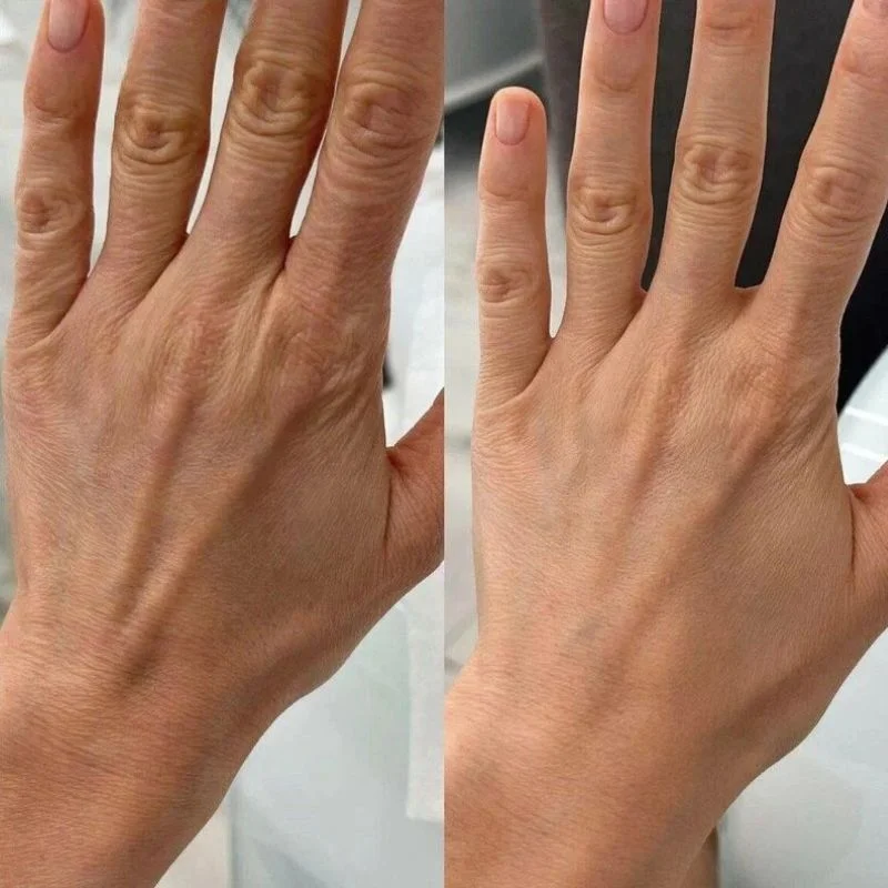 restoring-youthful-hands-and-softening-visible-veins